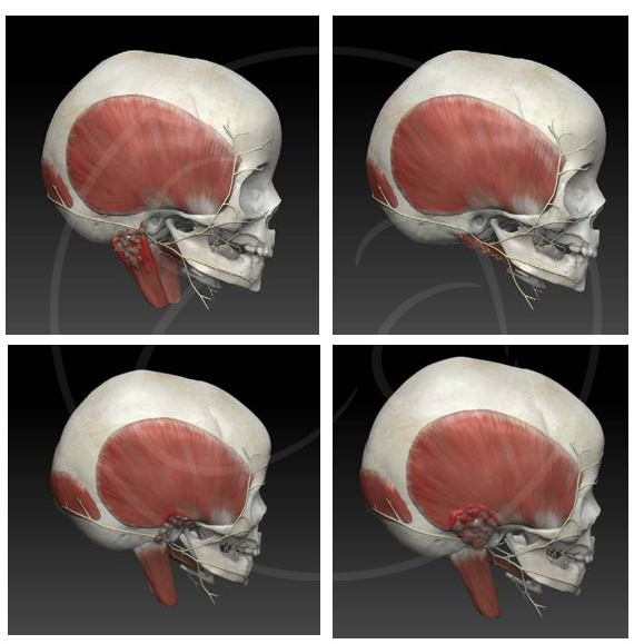 Complications of Mastoiditis (Zbrush) https://emadamsinc.com/portfolio/mastoiditis/